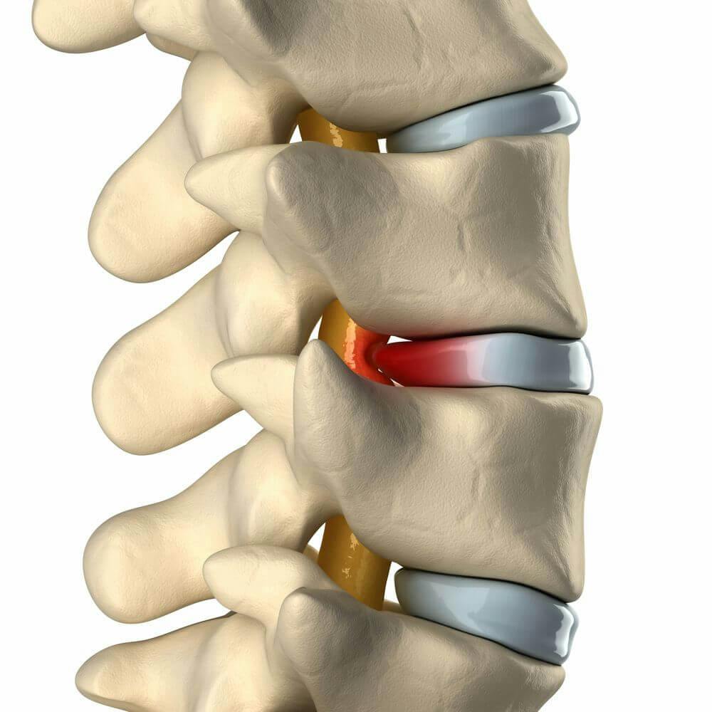 Featured image for: How to Heal a Herniated Disc