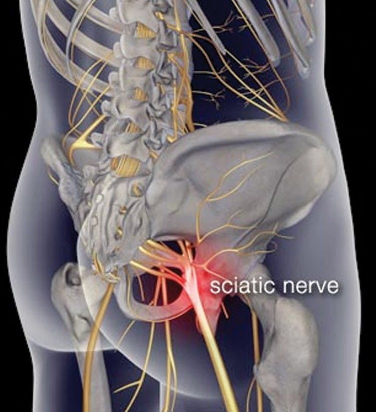 Cover image for: Sciatica, What It Is and How to Reduce Pain